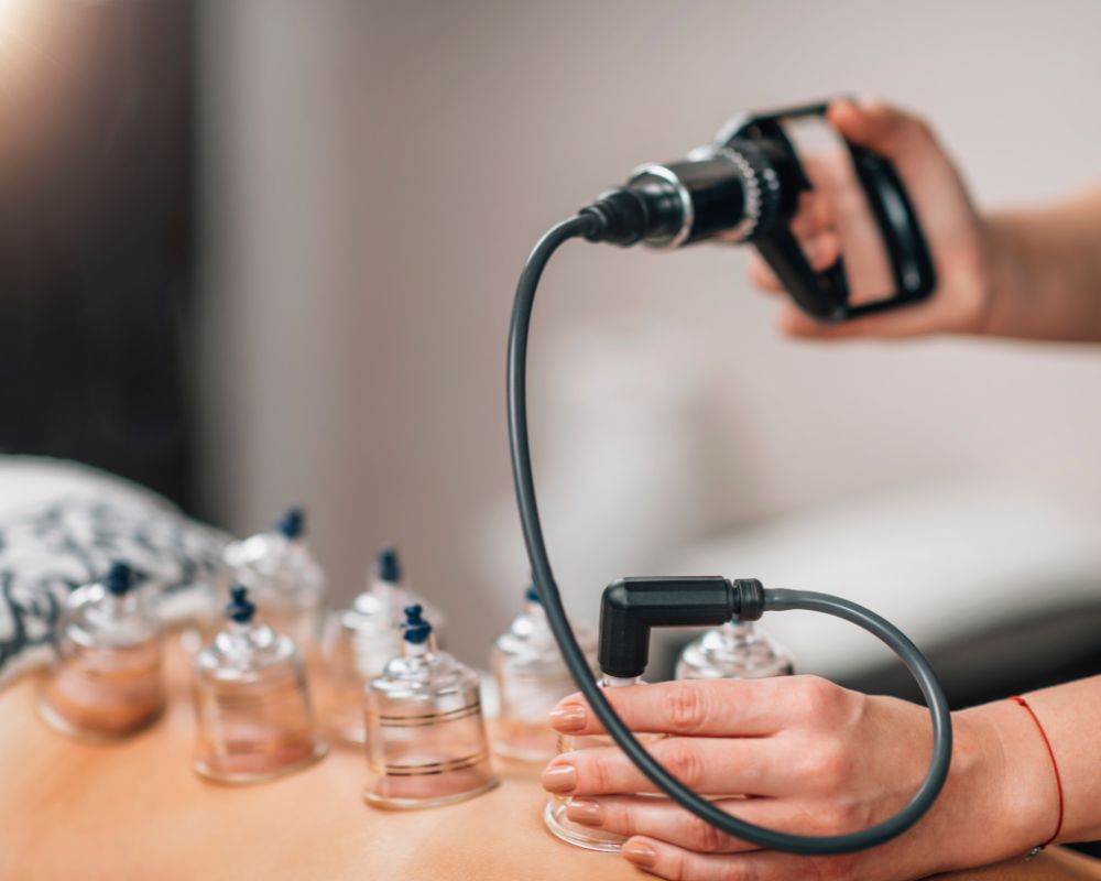 Bekam (Cupping Therapy)